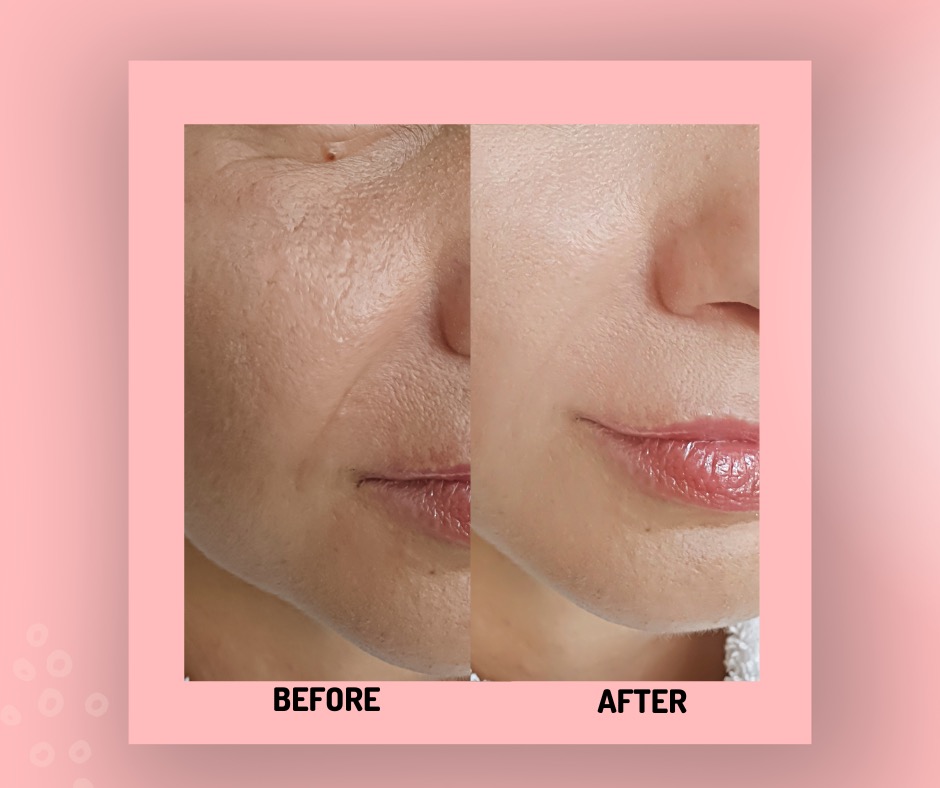 cold peel before and after